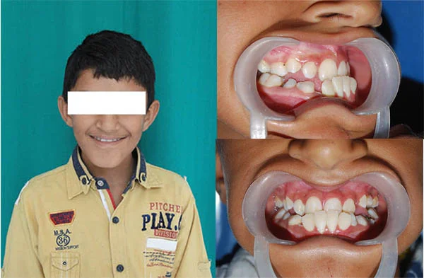 Before and After