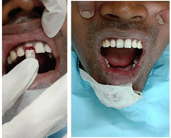 Before and After