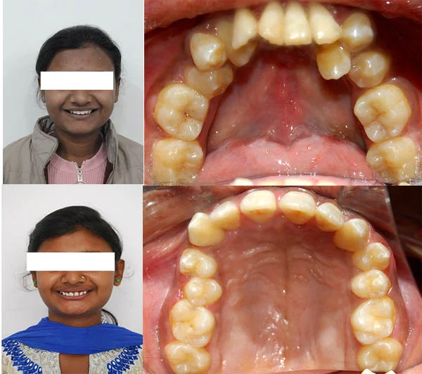 Before and After