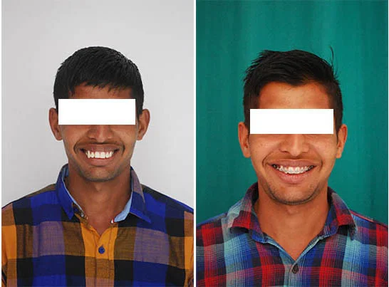 Before and After