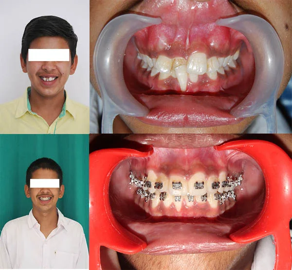 Before and After