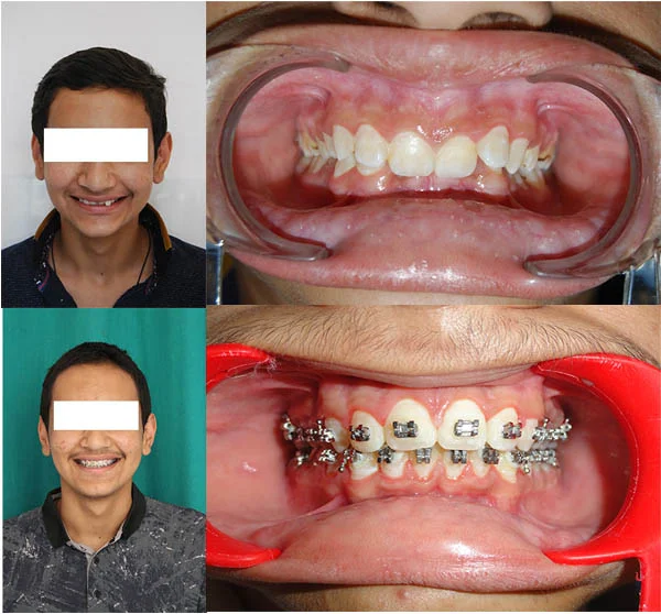 Before and After