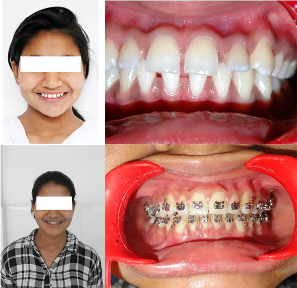 Before and After