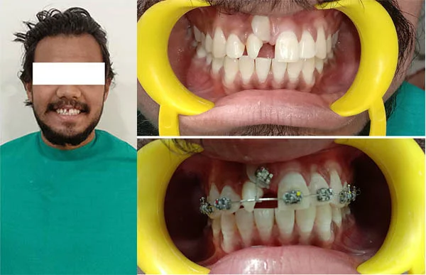 Before and After