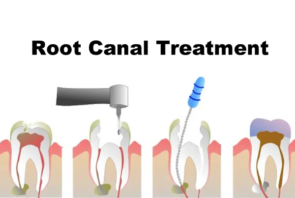 Root Canal Treatment
