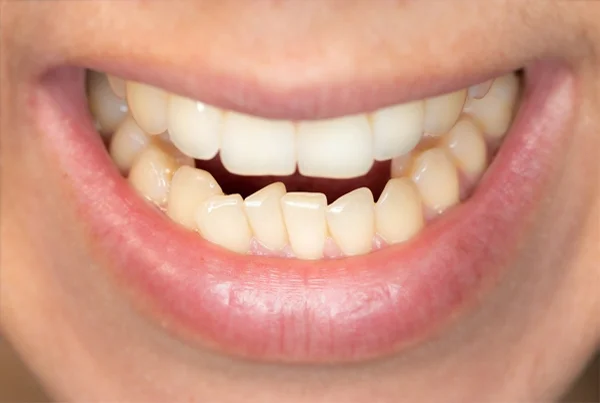 Tooth Reshaping
