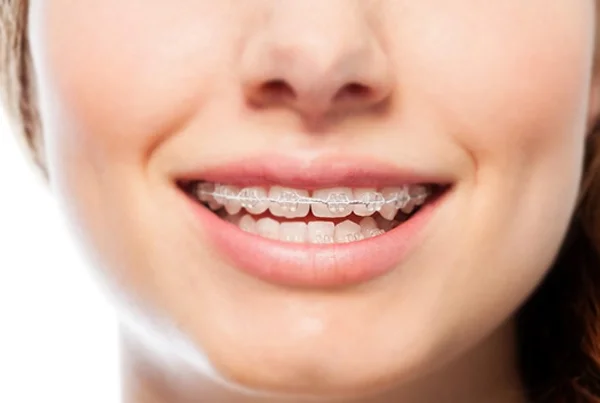 Ceramic Braces