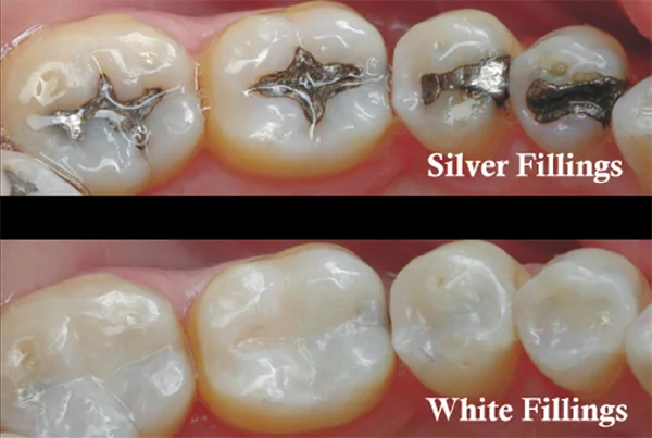 Tooth Color Fillings