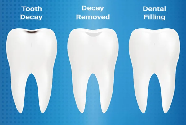 Fillings