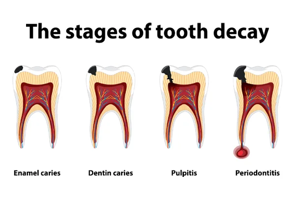 Decayed Tooth Treatment