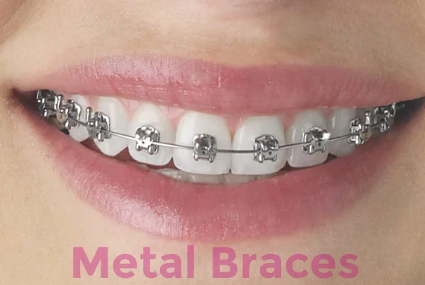 Orthodontic Treatment